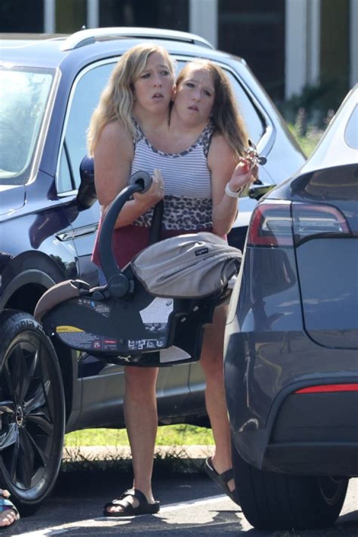 Abby And Brittany's Pregnancy: A Medical Wonder