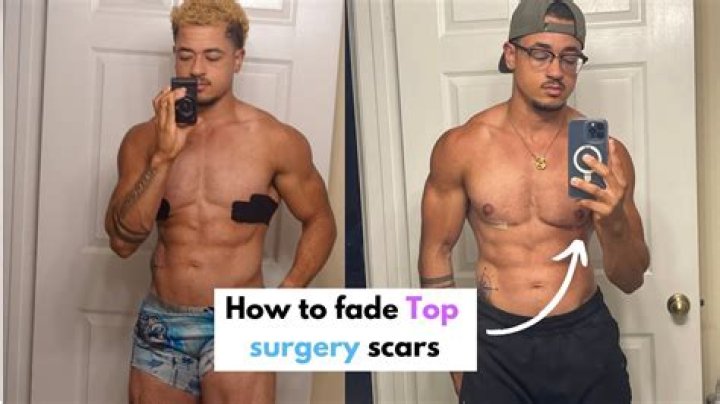 Get Expert Top Surgery From Leon Brown: Transformative Results, Enhanced Confidence