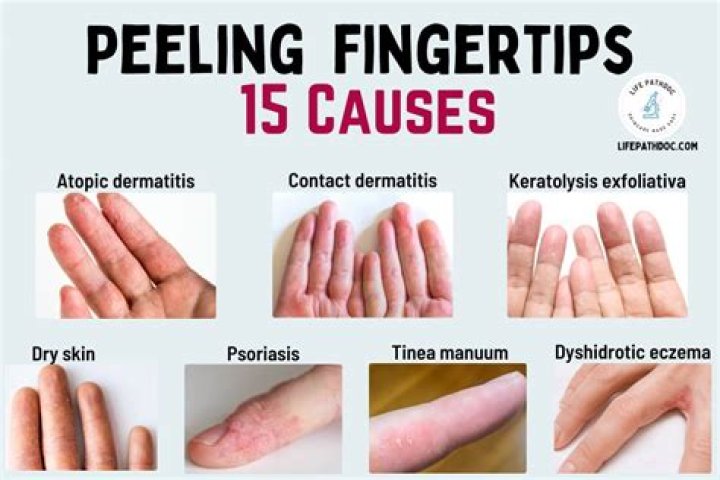 Protect Your Skin: Hisashi Skin Falling Off, Causes And Remedies