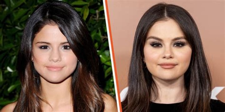 Troubling Signs: Selena Gomez's Facial Health Under Scrutiny
